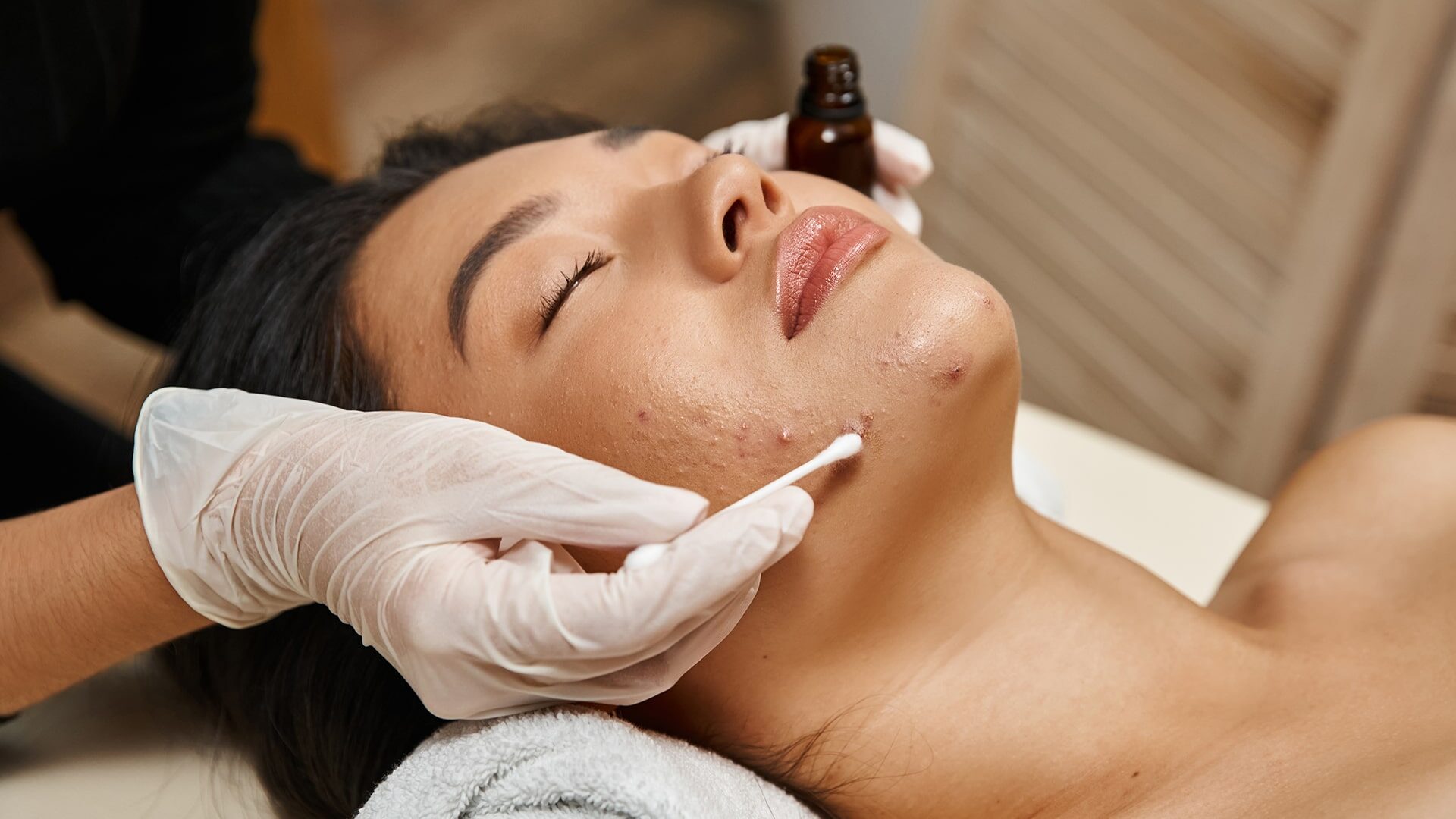 Acne Facial