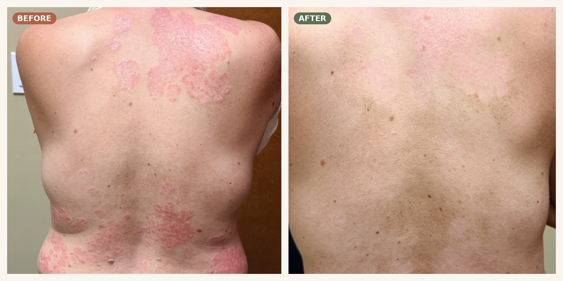 K.'s back before and after Panchakarma — widespread psoriasis plaques cleared