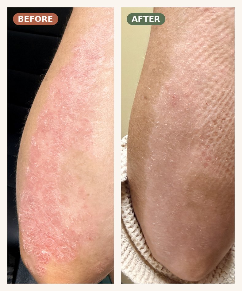 K.'s right forearm before and after Panchakarma — scaly psoriasis cleared