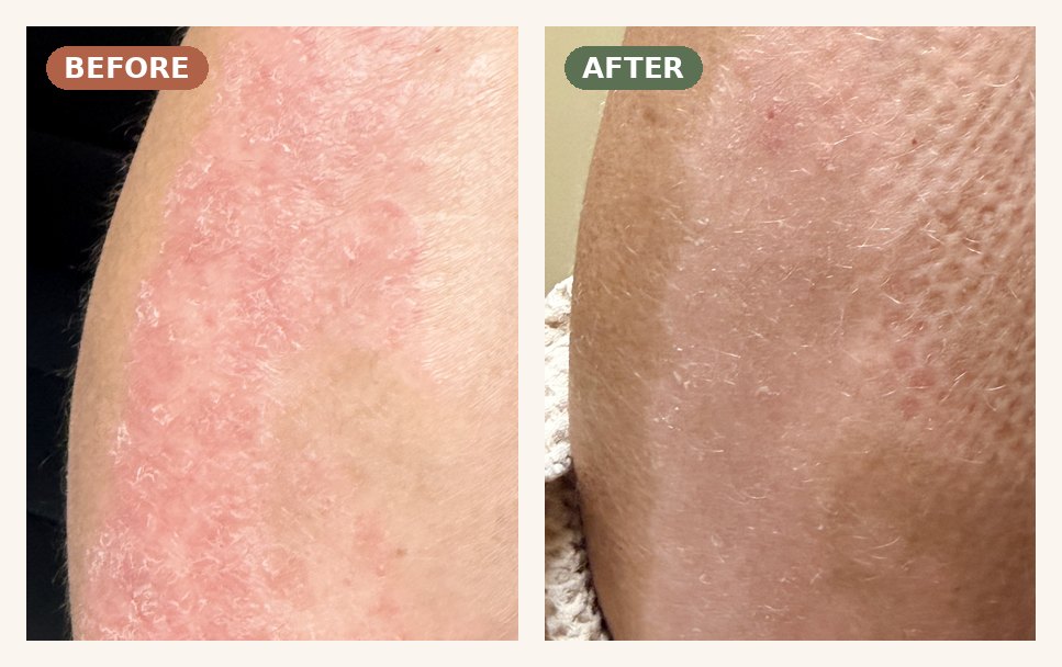 After 30 Years of Psoriasis, K. Found Relief Through Panchakarma